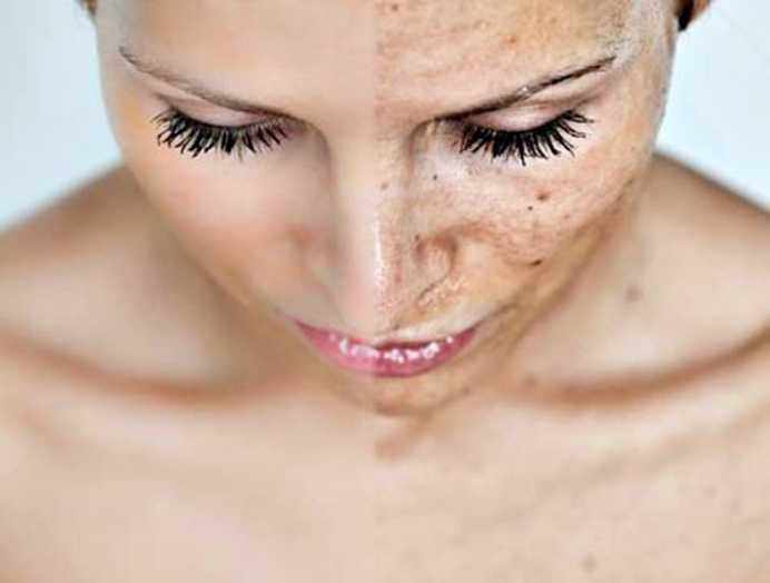 Freckles.. Why do they appear? Check these 5 ways to get rid of them!
