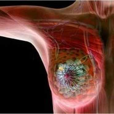 αποσμητικά και καρκίνος του μαστού