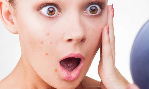 Acne: A Breakthrough Treatment with Biological Ingredients