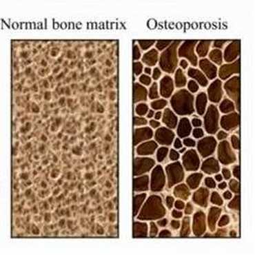 Osteoporosis : Reverse the disease with natural cures!
